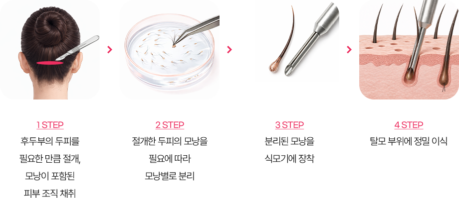 절개 모발이식 수술방법
