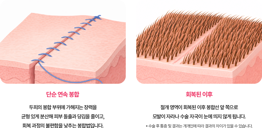 흉터 걱정을 줄이는 절개 봉합법