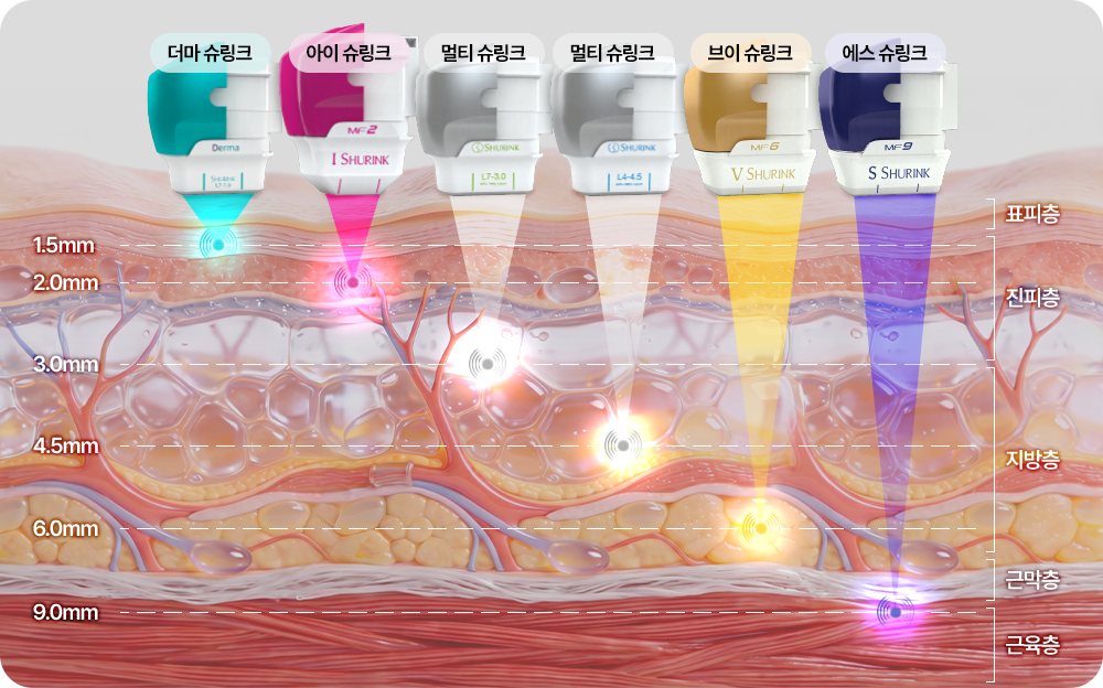 피부 속 깊숙한 SMAS층까지 리프팅