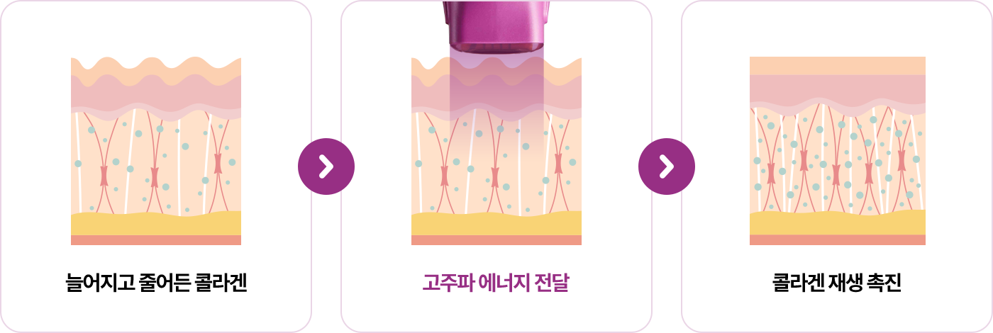 늘어지고 줄어든 콜라겐 > 고주파 에너지 전달 > 콜라겐 재생 촉진