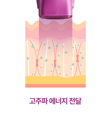 고주파 에너지 전달