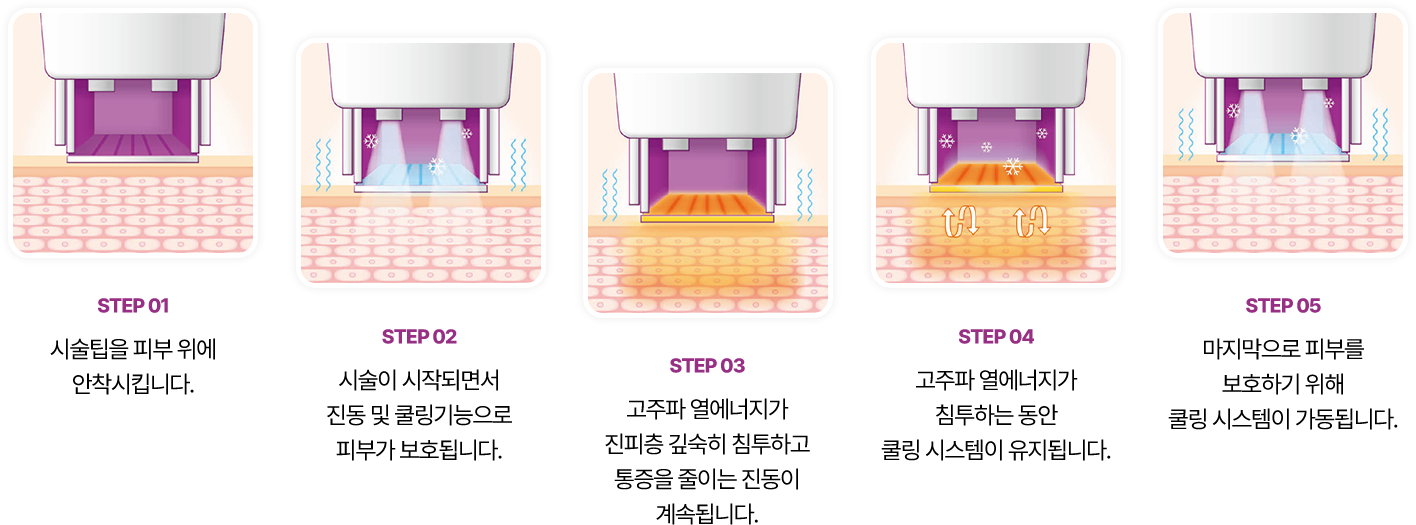STEP