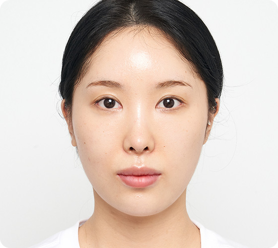 #필러 #보톡스 #듀얼라인리프팅 #윤곽주사