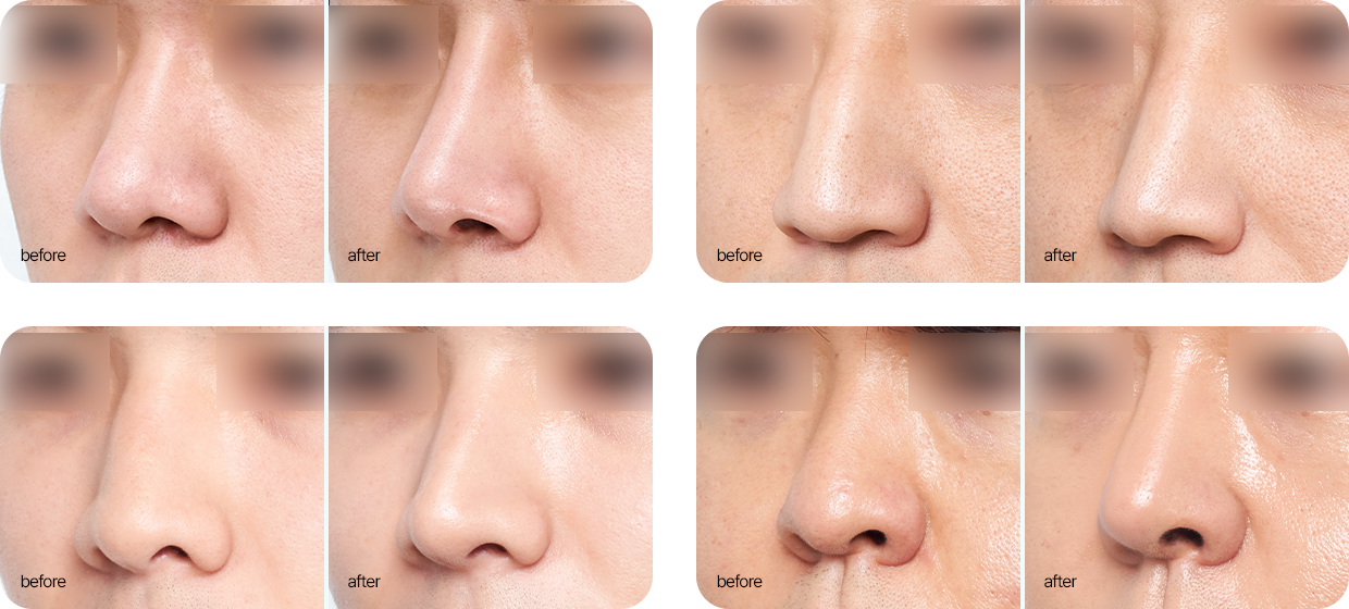 남자 코성형 전후 사진