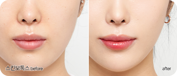 스킨보톡스 Before & After