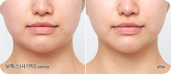 보톡스(사각턱) Before & After