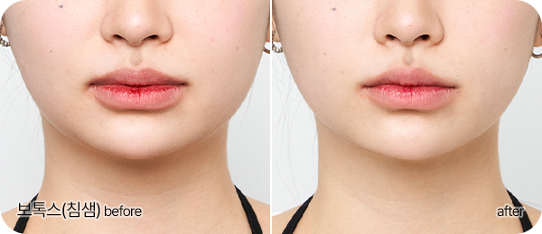 보톡스(침샘) Before & After
