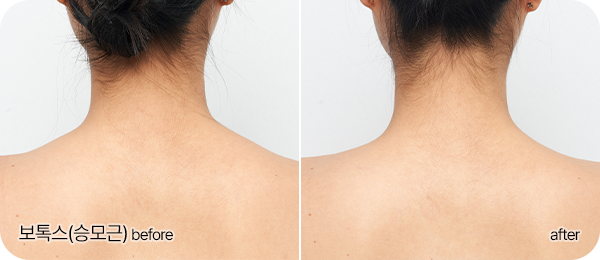 보톡스(승모근) Before & After