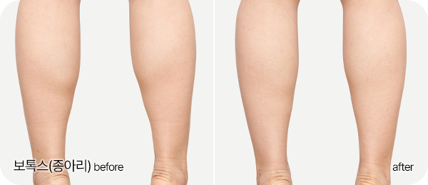 보톡스(종아리) Before & After