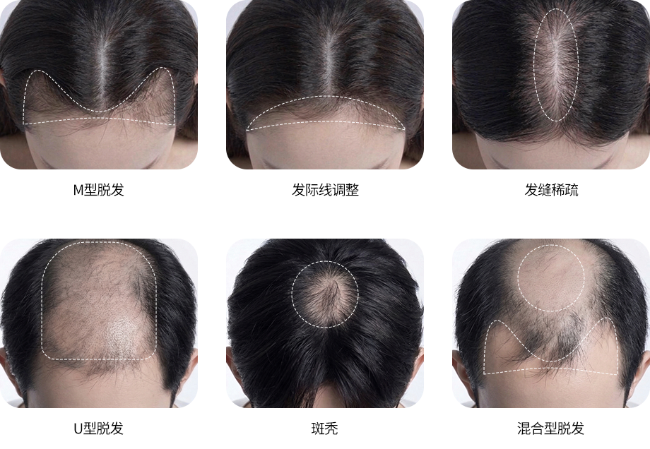 毛发移植适应部位