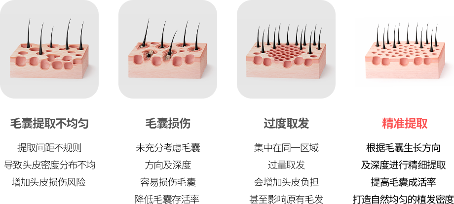 无痕毛发移植优势