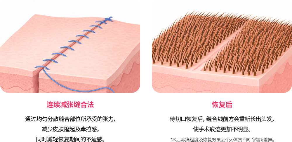 흉터 걱정을 줄이는 절개 봉합법