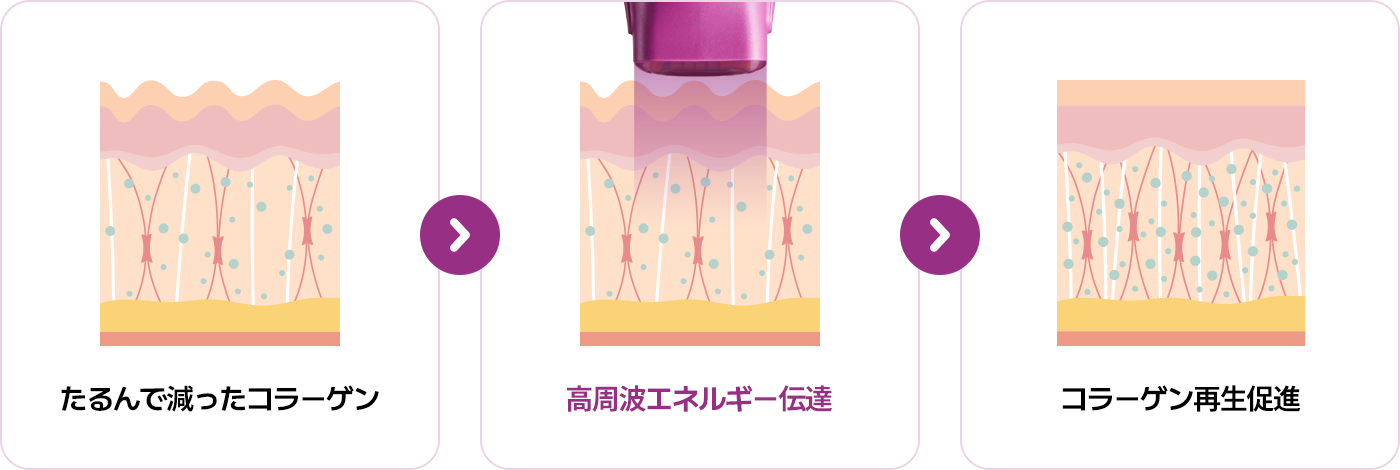 늘어지고 줄어든 콜라겐 > 고주파 에너지 전달 > 콜라겐 재생 촉진